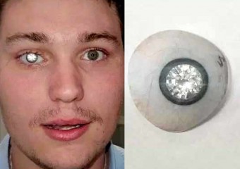 Ювелір вставив собі в око діамант
