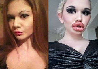 Жінка із найбільшими у світі губами шокувала змінами у зовнішності