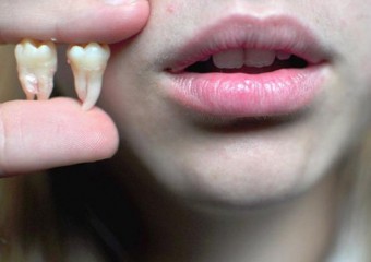 Чому зуби мудрості з’являються не в кожного