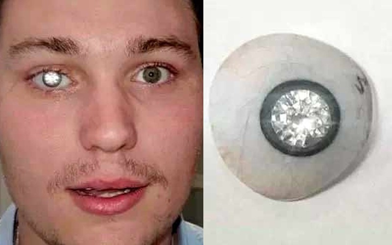 Ювелір вставив собі в око діамант